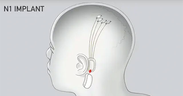 Thử Nghiệm Cấy Chip Não Của Neuralink: Bước Đột Phá Trong Công Nghệ Y Tế
