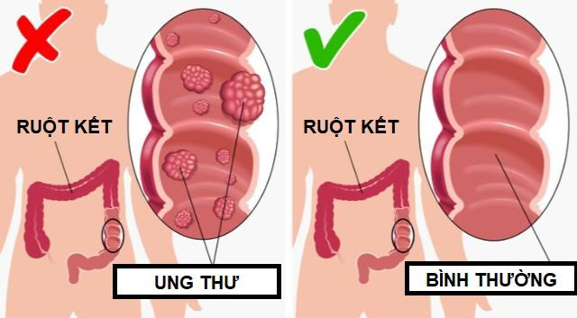 Giảm thiểu nguy cơ ung thư