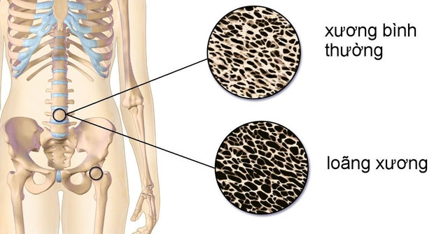 4 Loại Thực Phẩm Cần Tránh Để Bảo Vệ Sức Khỏe Xương Khớp