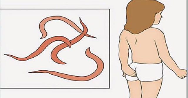 Cách nhận biết và xử trí giun kim ở trẻ: biện pháp tại nhà và lưu ý cần biết
